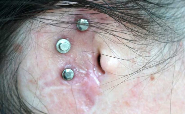 Magnetpunkte zur Befestigung einer Ohrepithese