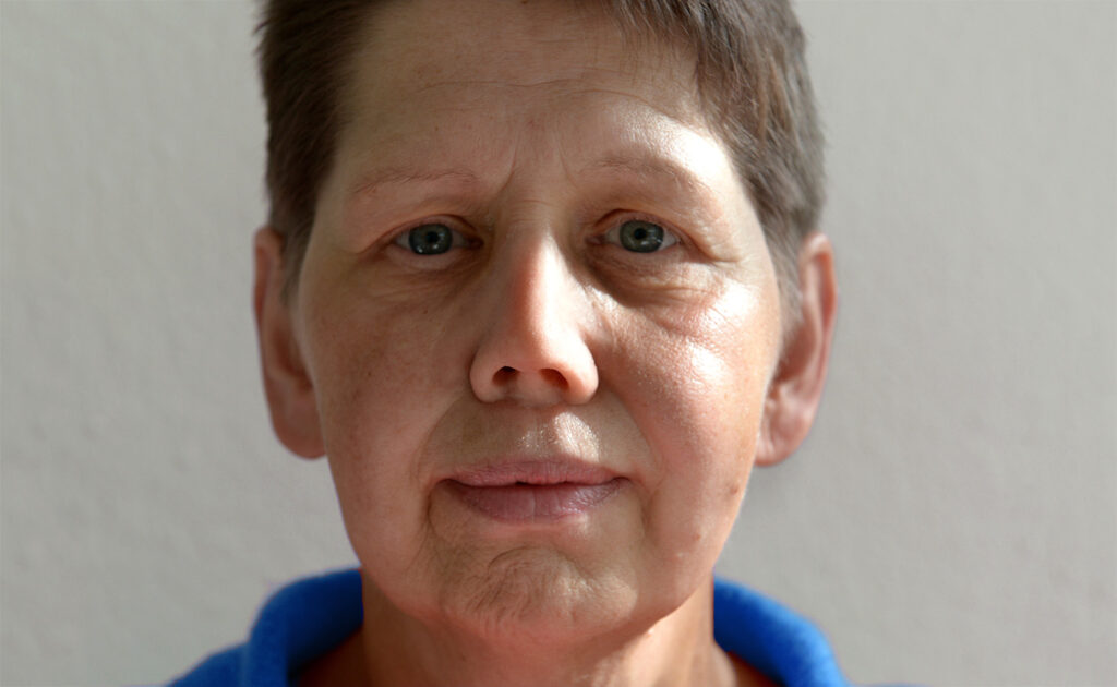 Frau mit Nasenepithese schaut in die Kamera